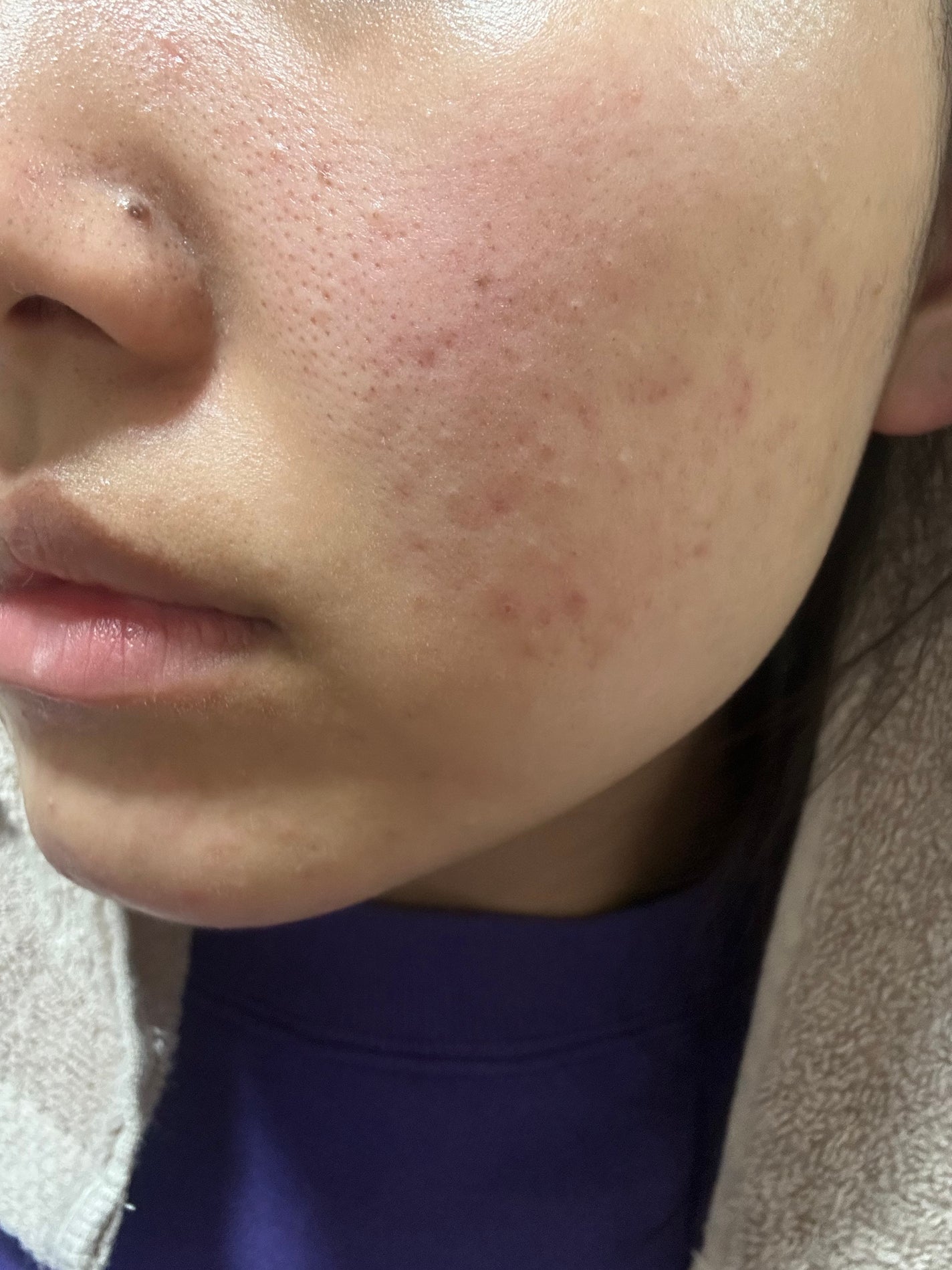 あ on LIPS 「ケミカルピーリング1回目終了好転反応なのか白ニキビ?がポツポツ..」(2枚目)