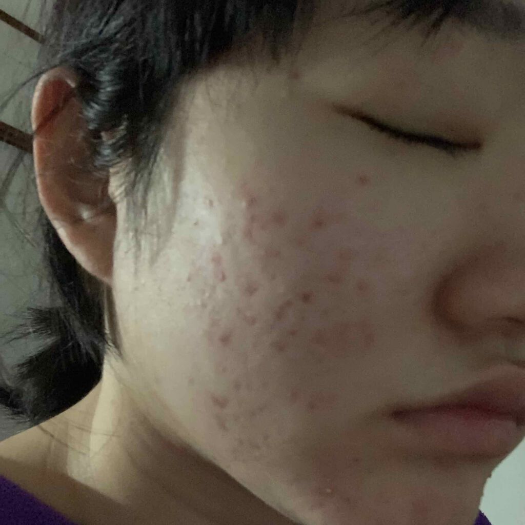 にきびちゃん゛ on LIPS 「ニキビ跡が全然治らなりません!べピオゲル使ってみようと思ってい..」(2枚目)