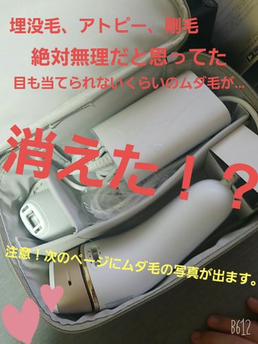 ～家電脱毛器で世界が変わった話🥰～

如何でもいい話ですが、
私は親の遺伝で小さい頃から剛毛、アトピーです。
アトピーはもうほぼ完治し、後は肌のブツブツが消えたら…！って感じです。

これ、アトピーある