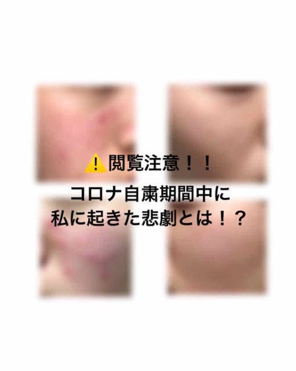 スキンケア洗顔料 薬用アクネケア/ビオレ/洗顔フォームを使ったクチコミ(1枚目)