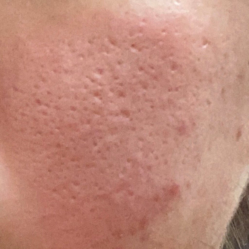 まいか on LIPS 「助けてほしいです!😭中学1年生位ならニキビができはじめてきづい..」(1枚目)