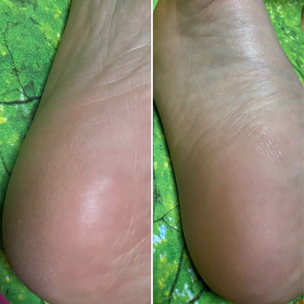 足用集中保湿パック/ドクター・ショール/レッグ・フットケアを使ったクチコミ(6枚目)