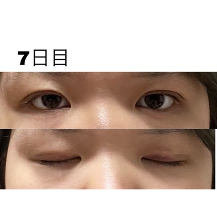 七瀬 on LIPS 「初投稿失礼します!この度ついに念願の二重埋没をしてきました〜!..」(9枚目)