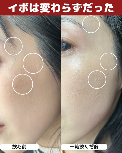 クラシエヨクイニンタブレット(医薬品)/クラシエ薬品/その他を使ったクチコミ(6枚目)