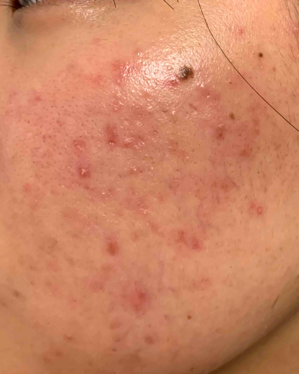 万年ニキビ肌 on LIPS 「5/7前回から3日後〜〜やっぱりじっくり熟成させて出来たニキビ..」(1枚目)