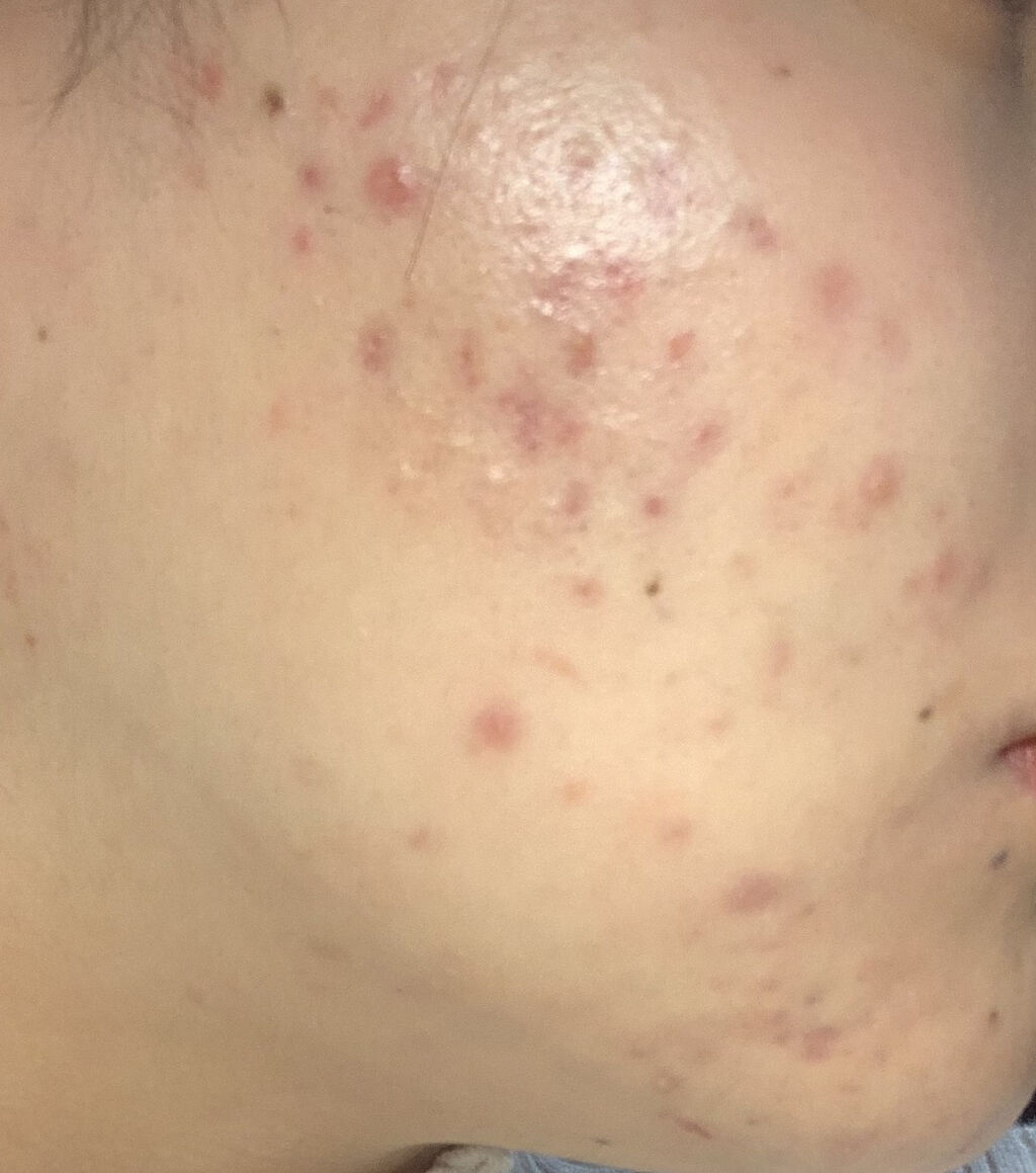 クリンダマイシンゲル(医薬品)/クラシエ薬品/その他を使ったクチコミ（2枚目）