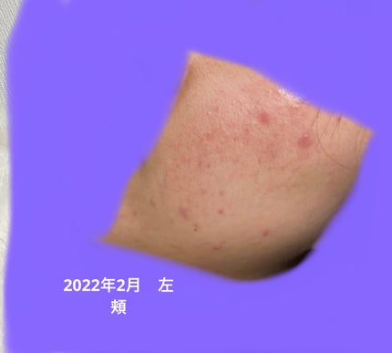 プリスクリードD(医薬品)/IHADA/その他を使ったクチコミ(2枚目)