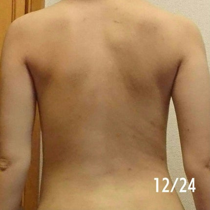 メンタームEXプラスクリーム(医薬品)/メンターム/その他を使ったクチコミ(3枚目)