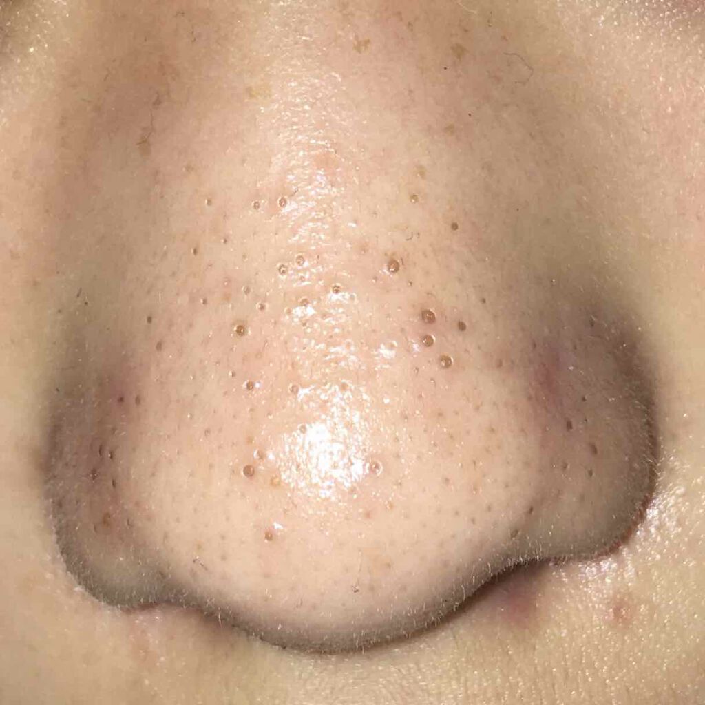 shiny_perfume_wilb on LIPS 「汚い写真失礼しますこんな状態の方いますか(;;)毛穴を押して角..」(1枚目)