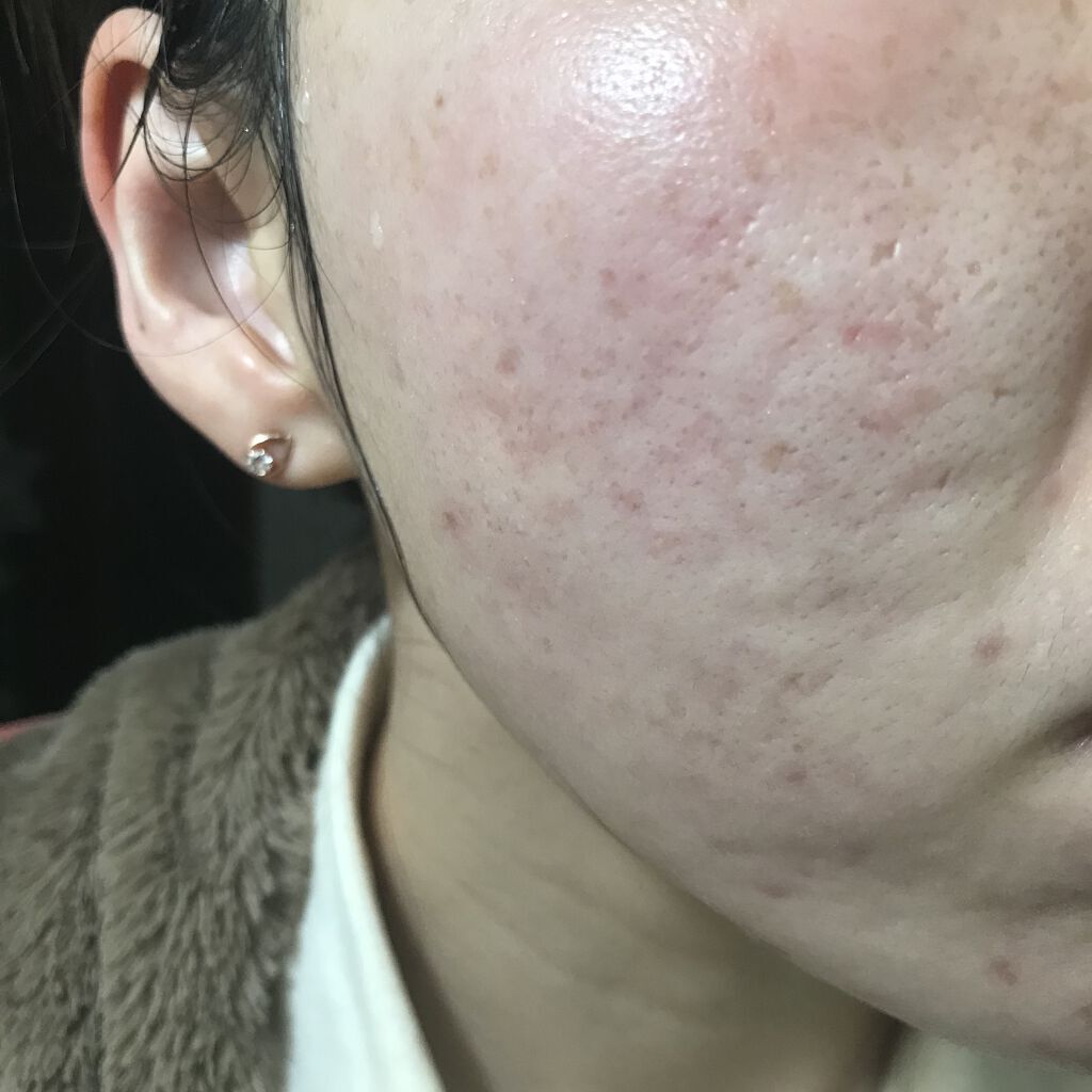 ビオオイル アルガンオイル Melvitaを使った口コミ 4 1 汚肌工事録あご白ニキビになっちゃ By Miina 汚肌 工事録 混合肌 代後半 Lips