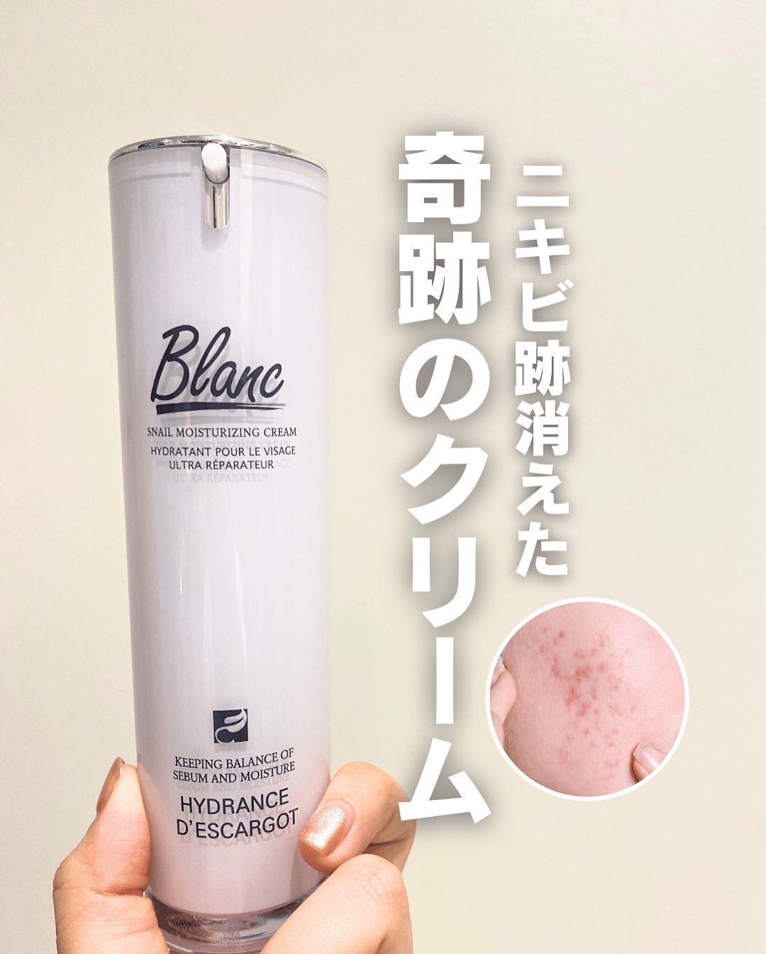 白湯(サユ) | ニキビと戦うOL🤍 on LIPS 「Qoo10のニキビ商品1位でお馴染みのティーツリーマジックオイ..」(1枚目)