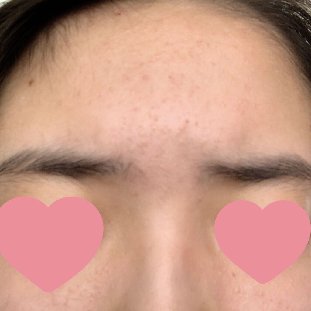 A アクネローション/NOV/化粧水を使ったクチコミ（3枚目）