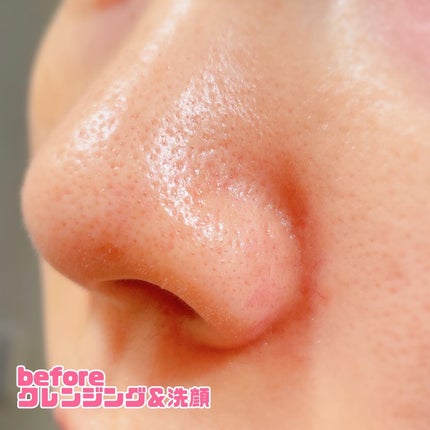 チョコブラ スペシャル毛穴ケアセット/Chocobra/スキンケアキットを使ったクチコミ(6枚目)