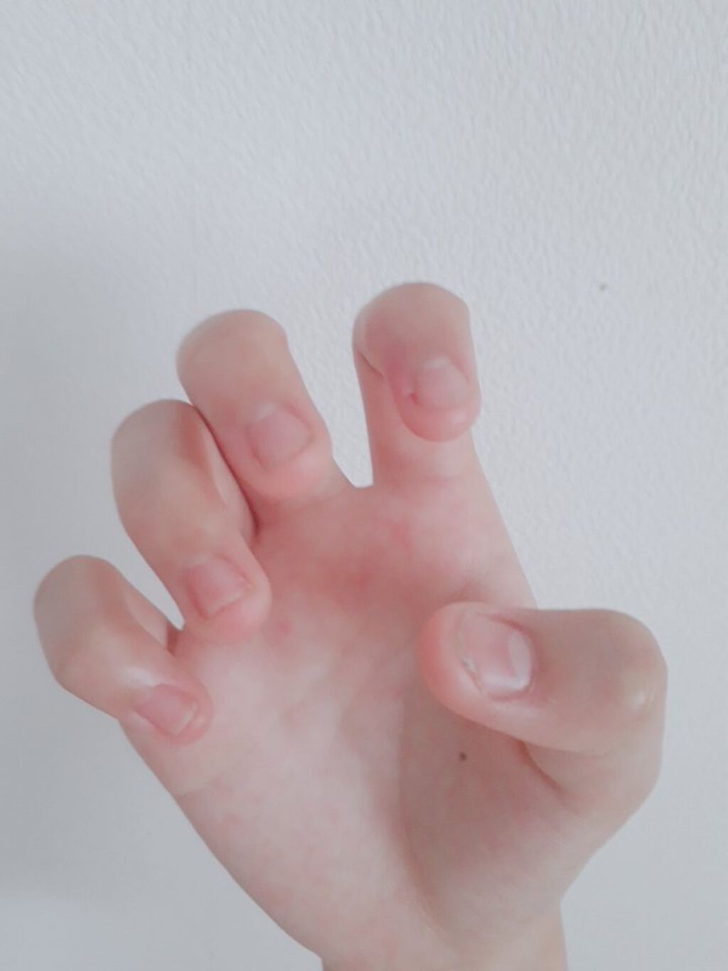 moeha on LIPS 「こんにちは!moehaです!「moehaの深爪脱出日記」3日目..」(3枚目)