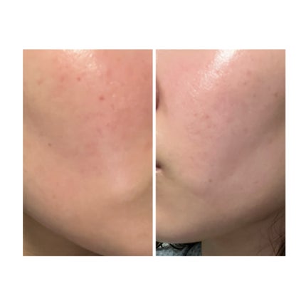 ぽむ on LIPS 「2023.9.13皮膚科に受診 エピデュオとヘパリン処方1枚目..」(4枚目)