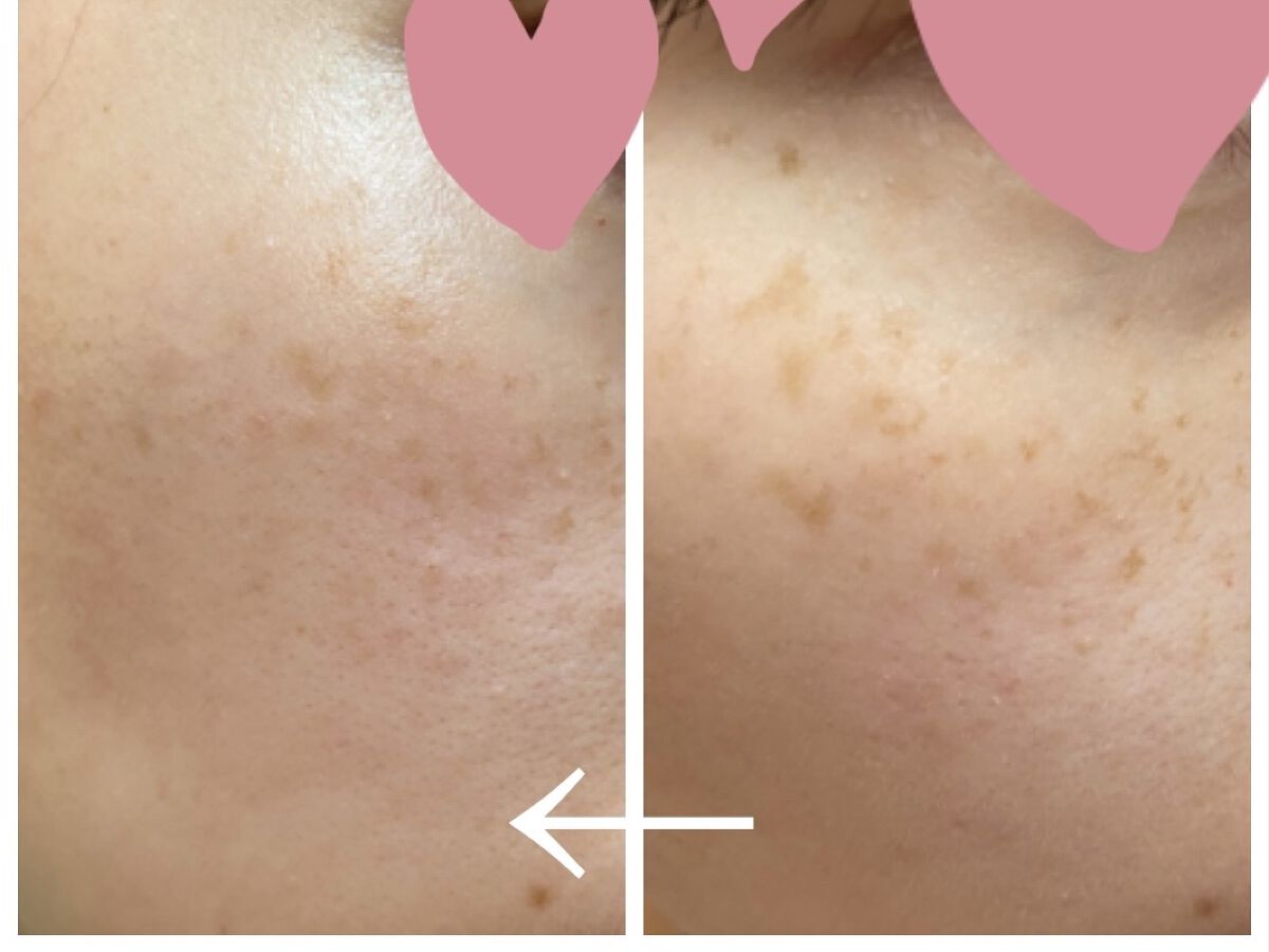 ビタペアC 集中美容液スペシャルセット/ネイチャーリパブリック/美容液を使ったクチコミ（3枚目）