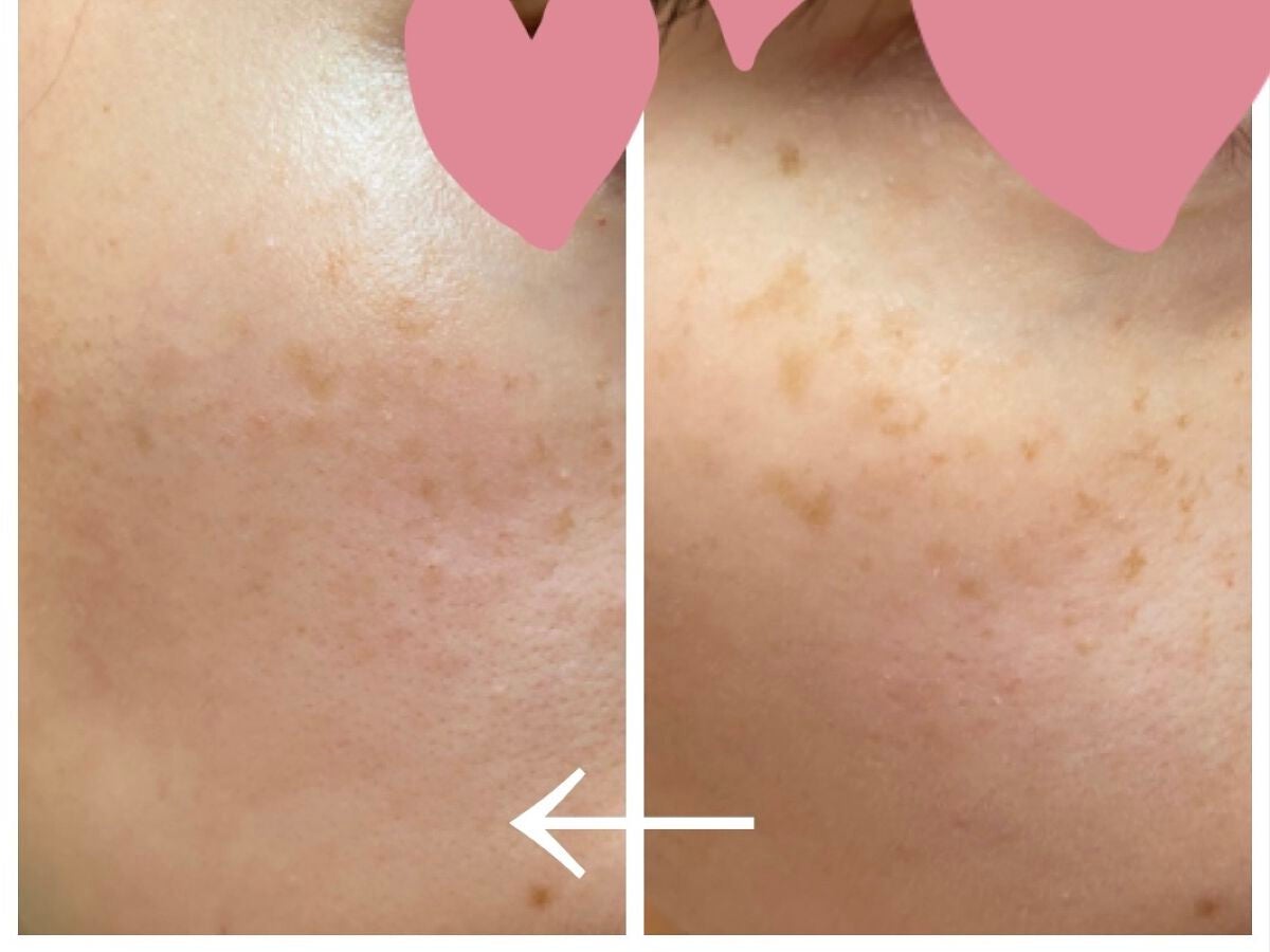 ビタペアC 集中美容液スペシャルセット/ネイチャーリパブリック/美容液を使ったクチコミ(3枚目)