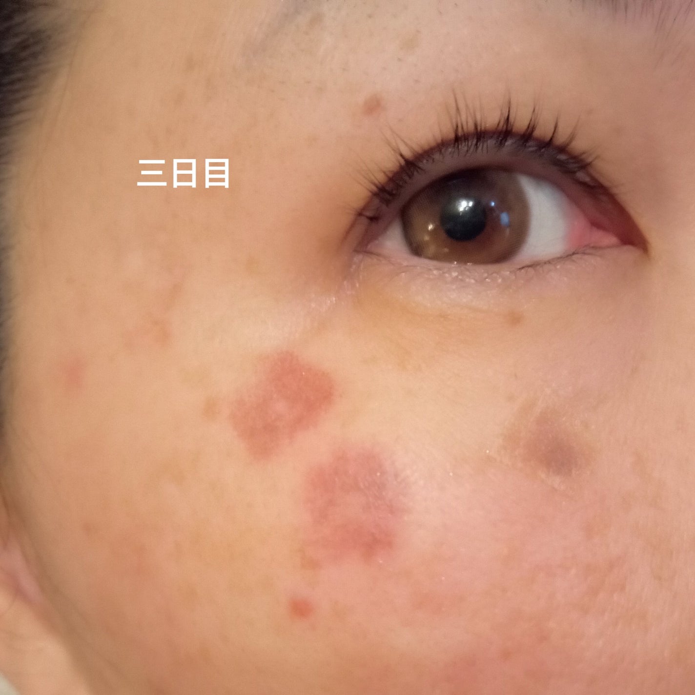 ビヨンセ奥二重向上委員長🥸LIPSパートナー🥳 on LIPS 「ついに!!この時が🤣🩷シミ取りレーザー全記録です🙌🙌🙌(五日目..」(6枚目)