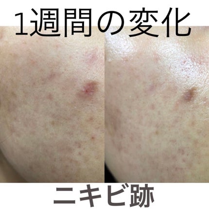 薬用しみ集中対策 プレミアム美容液/メラノCC/美容液を使ったクチコミ(1枚目)