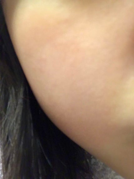 ニキビ治療薬クリーム (医薬品)/クレアラシル/その他を使ったクチコミ(4枚目)