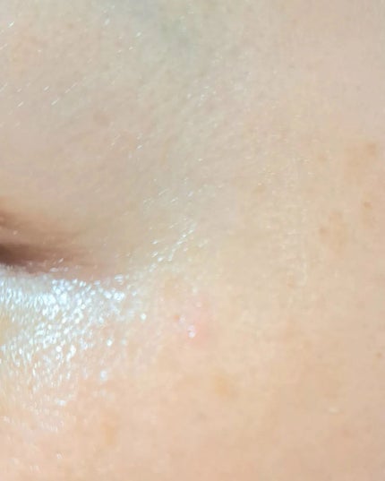 アンティア モイストバランサー/ドクターベルツ/化粧水を使ったクチコミ(7枚目)