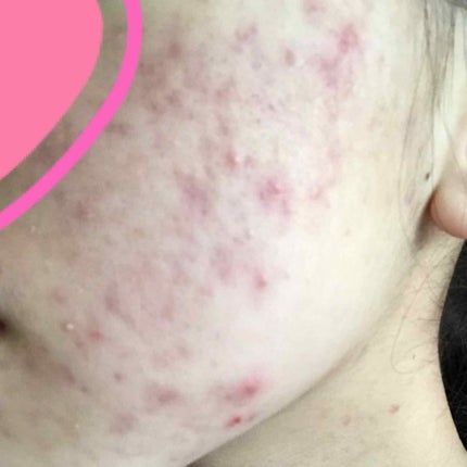 薬用しみ対策 美白化粧水/メラノCC/化粧水を使ったクチコミ(3枚目)