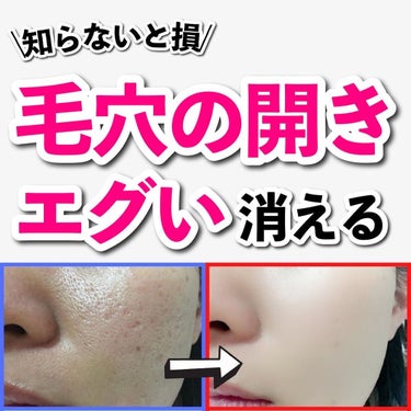 あなたの肌に合ったスキンケア💐コーくん on LIPS 「【知らないと損】毛穴の開きエグい消える方法🤫　..あなたの毛穴..」（1枚目）