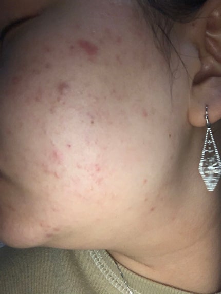 ティーツリーケア ソリューション エッセンシャルマスクEX/MEDIHEAL/シートマスク・パックを使ったクチコミ(3枚目)