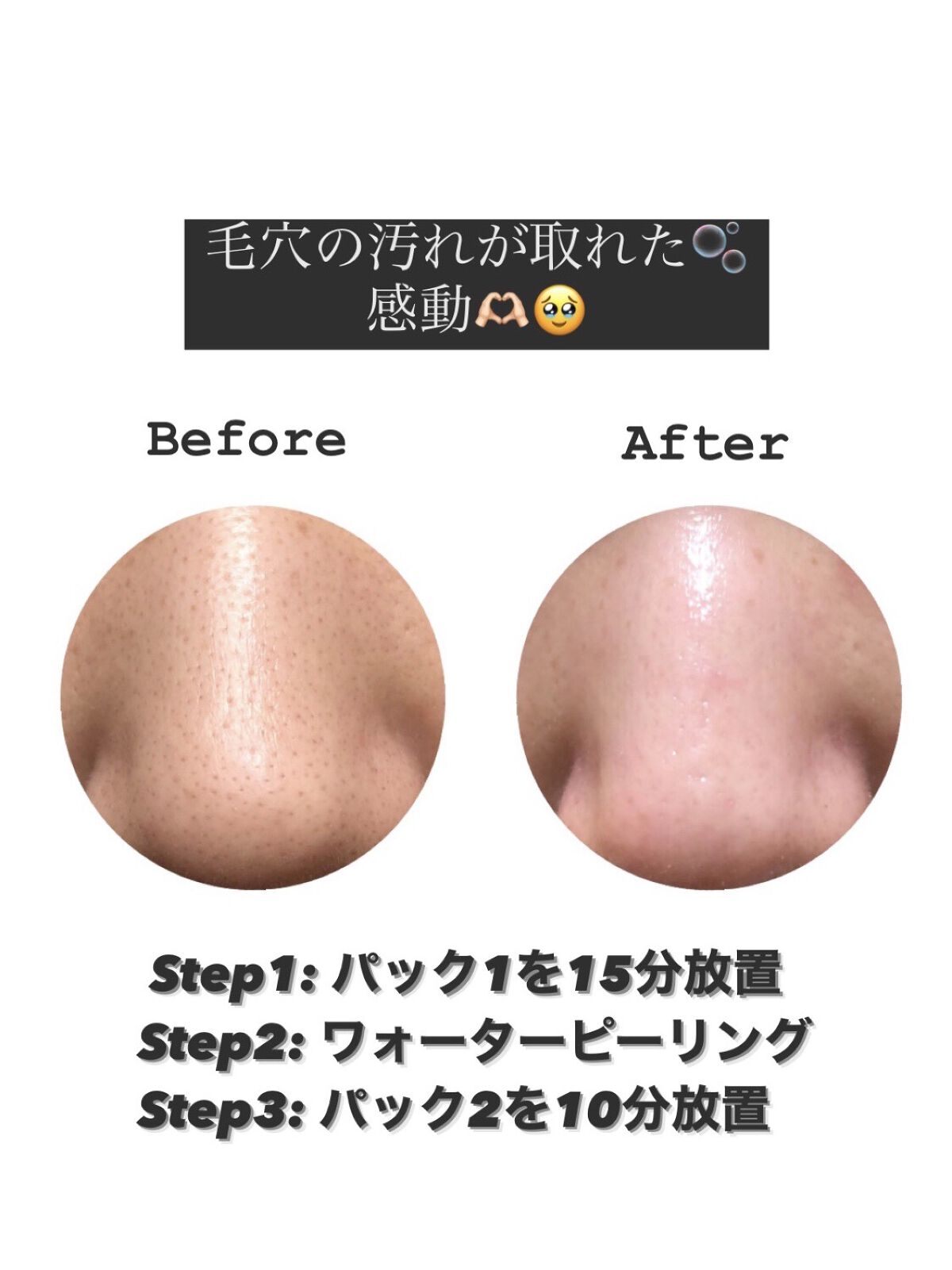 アンチポアブラックヘッドパーフェクトクリアキット/CNP Laboratory/シートマスク・パックを使ったクチコミ（2枚目）