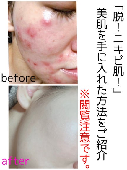 タカミスキンピール/タカミ/ブースター・導入液を使ったクチコミ(1枚目)