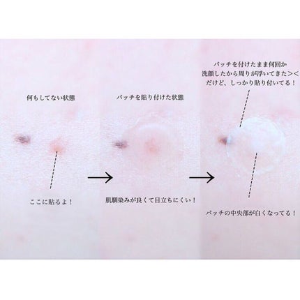 ゼロスポットパッチ/Today’s Cosme/にきびパッチを使ったクチコミ(5枚目)
