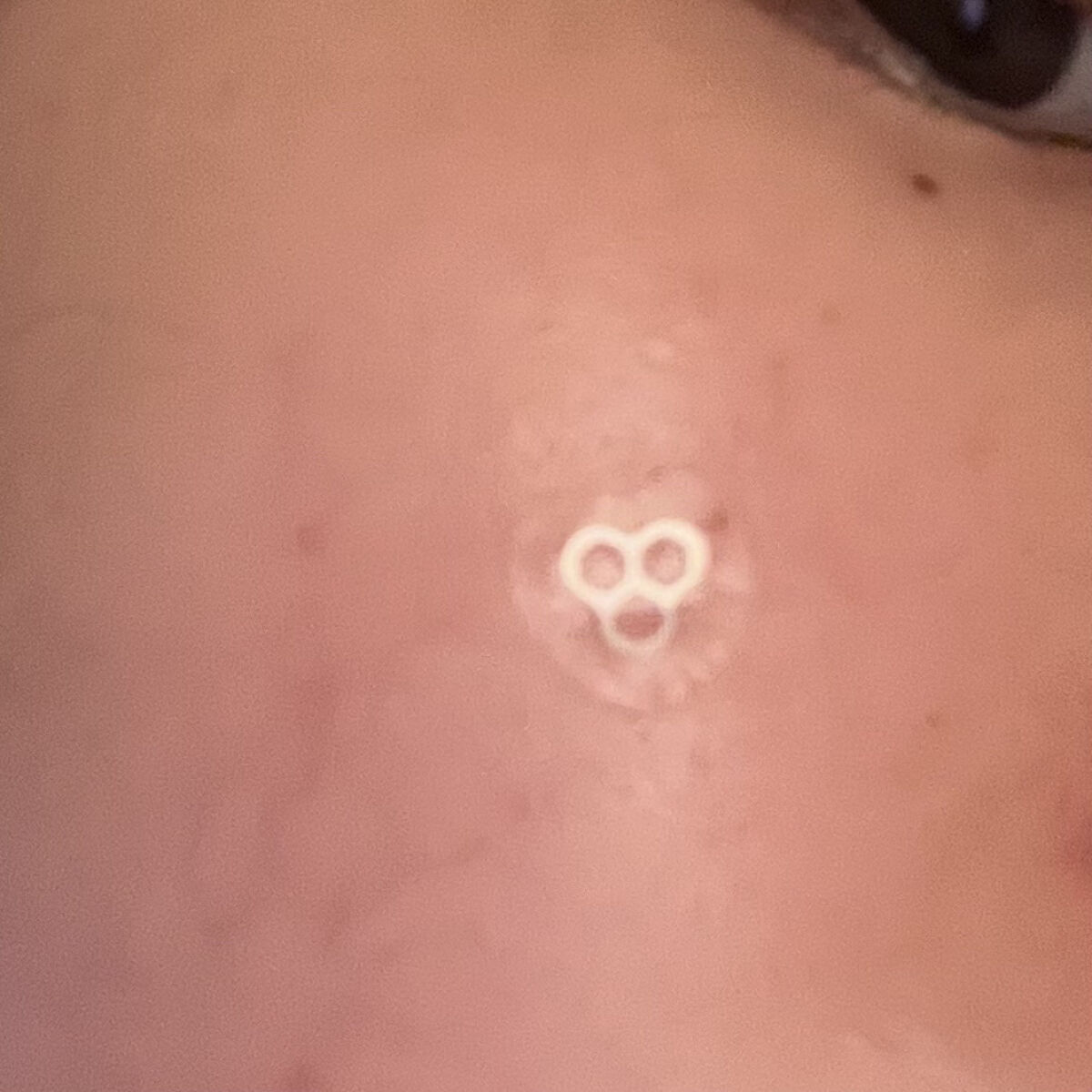 ACマグネシウムパッチ　ミニ/スノーツープラス/にきびパッチを使ったクチコミ（3枚目）