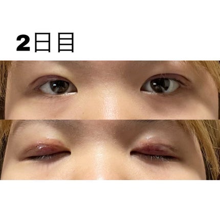 七瀬 on LIPS 「初投稿失礼します!この度ついに念願の二重埋没をしてきました〜!..」(4枚目)