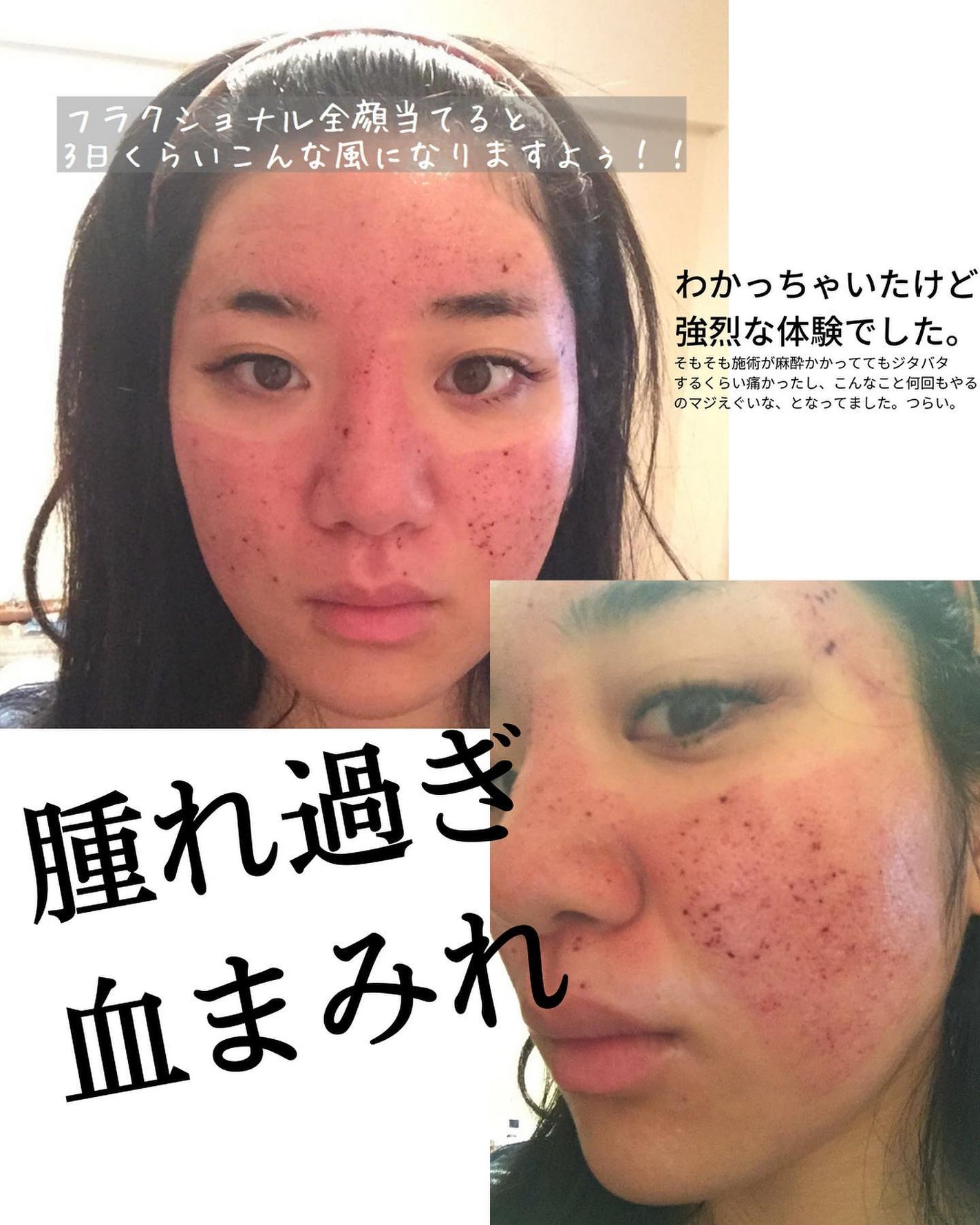おゆみ|ニキビ・ニキビ跡ケア on LIPS 「【しくじり先生②早まるな、肌爆撃!💣】こんばんは、おゆみです💁..」(5枚目)