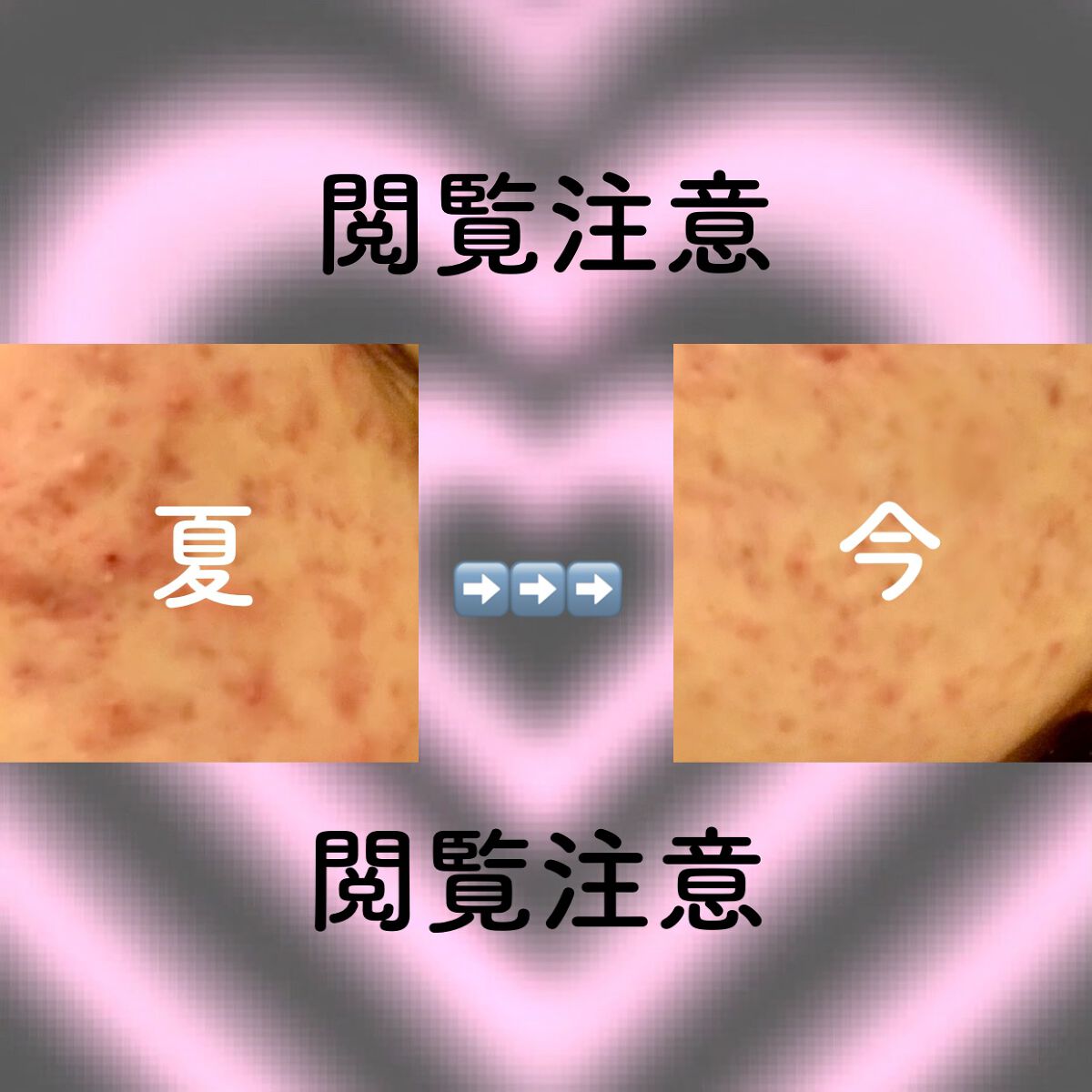 じゃーじゃー麺😳ིྀ on LIPS 「CICACHOI!オロナインメラノCC何使っても効かない私の最..」(2枚目)