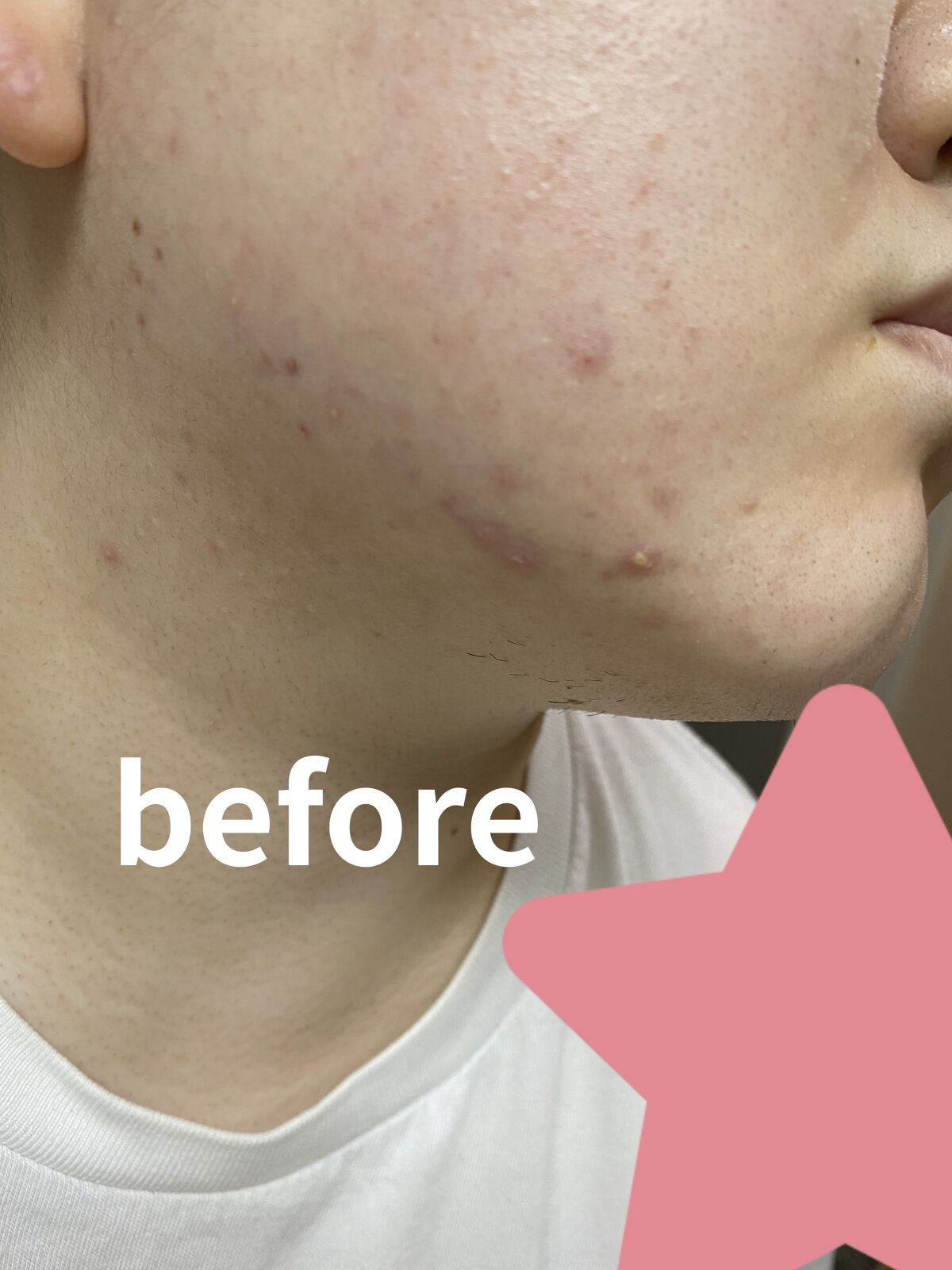 ヘパトリート 薬用保湿化粧水/ゼトックスタイル/化粧水を使ったクチコミ（1枚目）