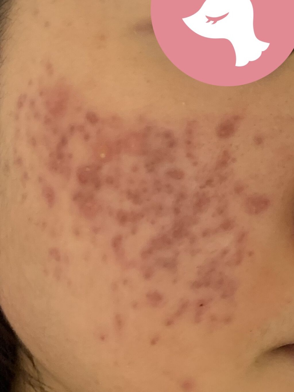 ヒルマイルドクリーム(医薬品)/健栄製薬/その他を使ったクチコミ（2枚目）