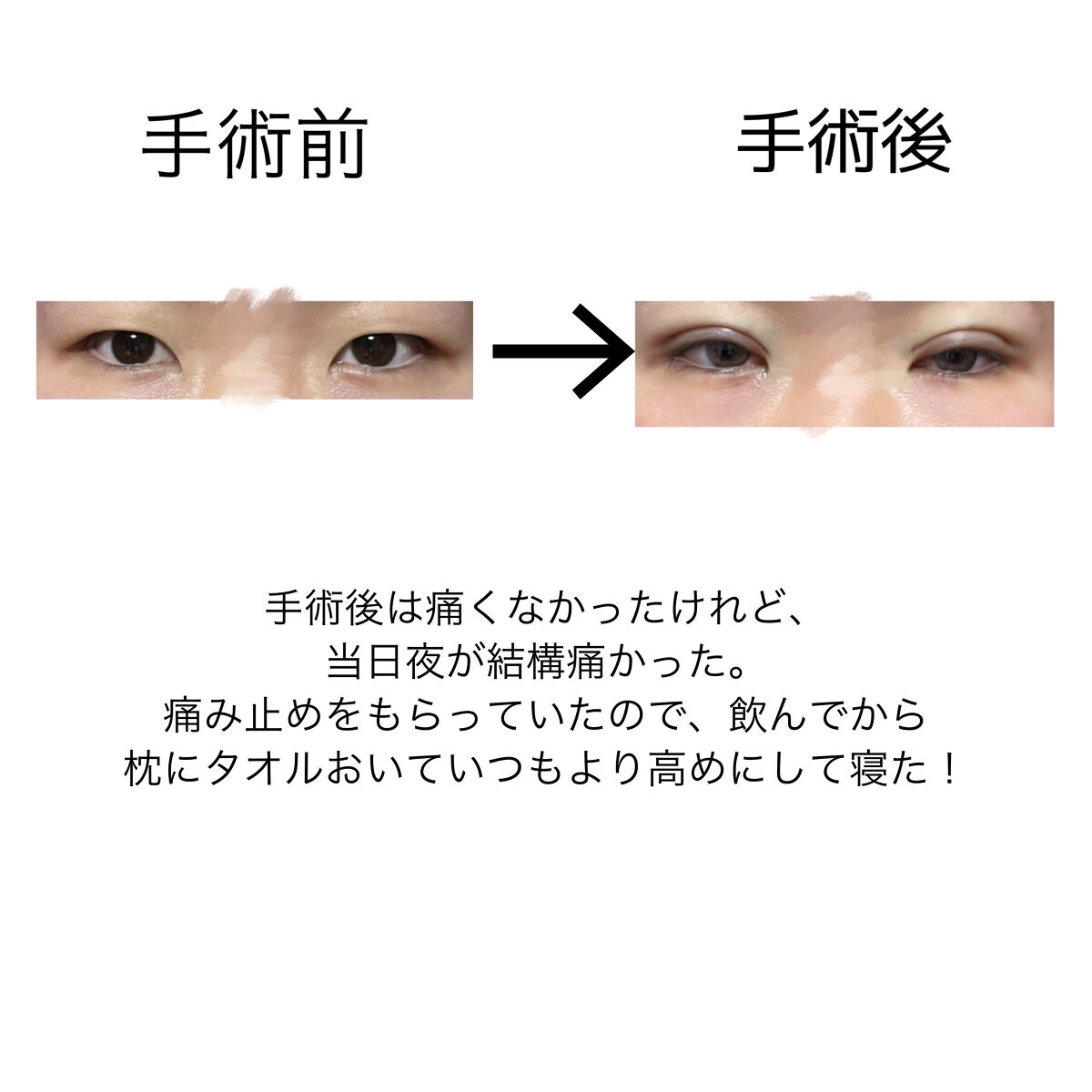 二重整形/その他を使ったクチコミ（2枚目）