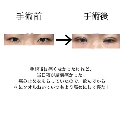 二重整形/その他を使ったクチコミ(2枚目)