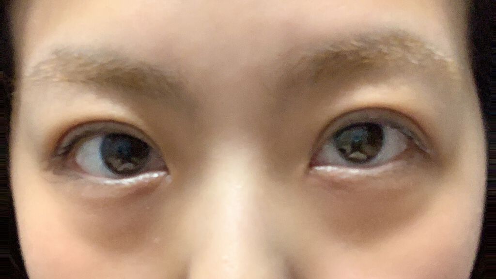 二重整形/その他を使ったクチコミ（1枚目）