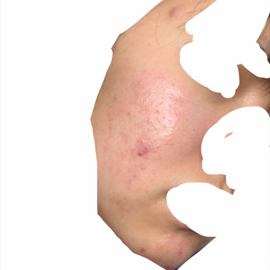 さき on LIPS 「ニキビ、ニキビ跡がすごいです。どうすればいいでしょうか😢また、..」(3枚目)