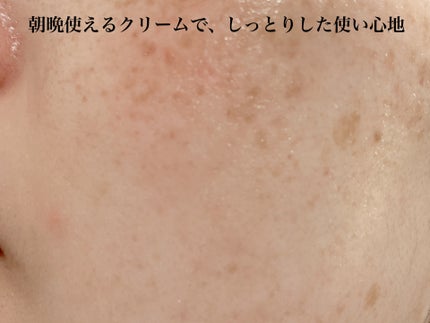 アセロラダークスポット&ブレミッシュ ケア クリーム/RAVIEL/フェイスクリームを使ったクチコミ(6枚目)