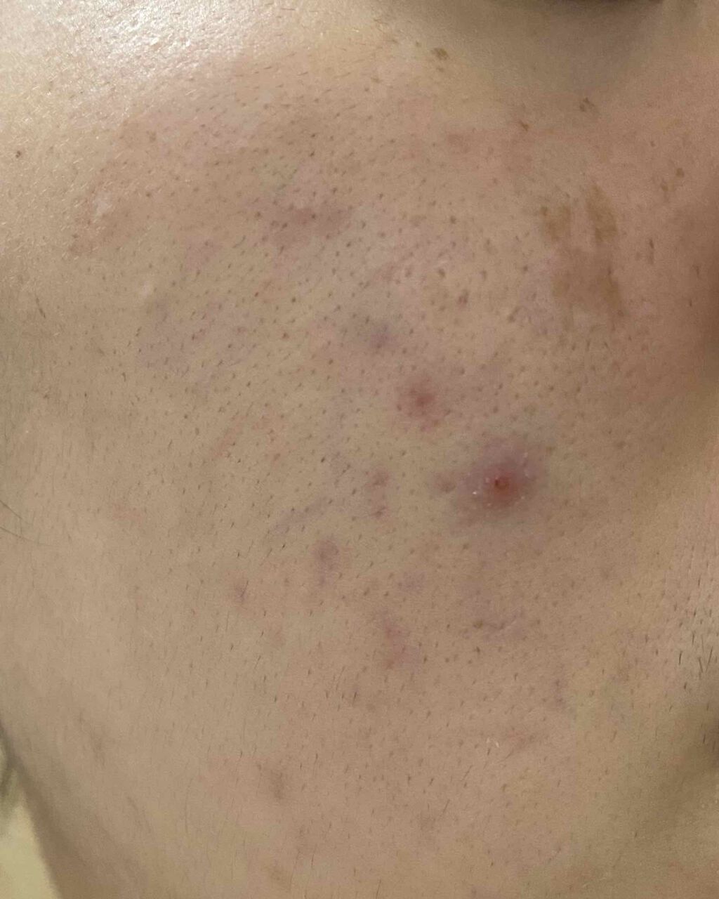 薬用しみ対策美白ジェル/メラノCC/フェイスクリームを使ったクチコミ（2枚目）