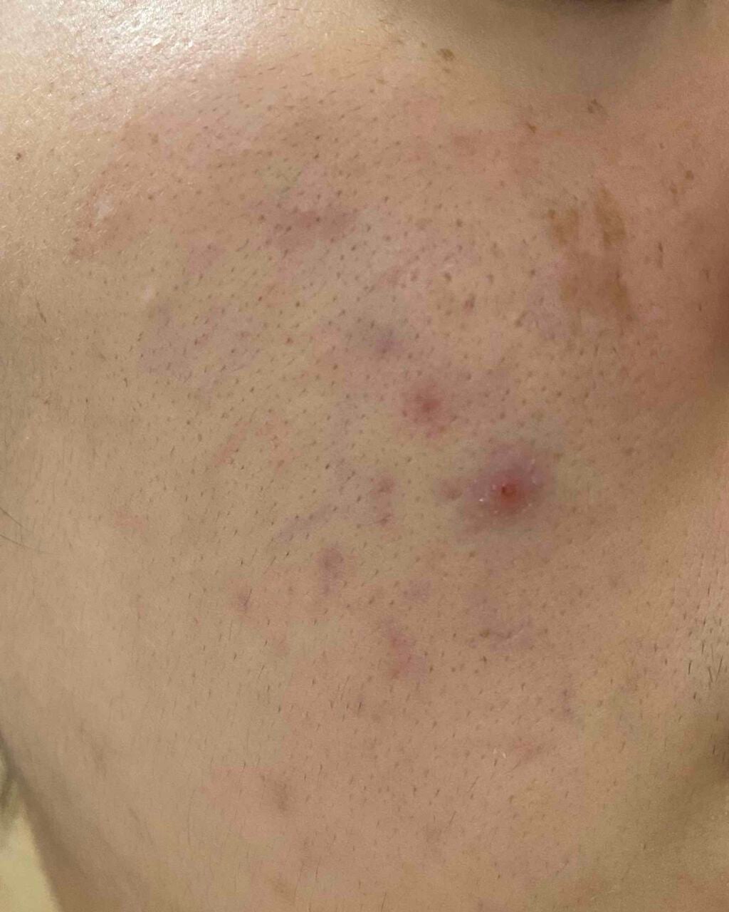 薬用しみ対策美白ジェル/メラノCC/フェイスクリームを使ったクチコミ(2枚目)