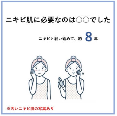 こんにちは🫶🏻💞　いくちゃんです。
と言っても、長らく投稿も何もしていなかったので、自分でも誰？となっています笑笑

自分の人生最大の悩みについて、話させて下さい。
それは、ニキビです。

泣きたいぐら