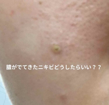 みんぐぅ on LIPS 「頬のニキビに薬を塗ると膿が出てきました…取ったら跡になるし、ど..」（1枚目）