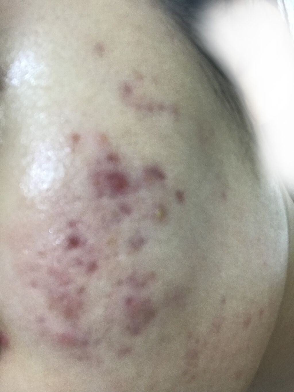 にきび治療薬C(医薬品)/ピンプリット/その他を使ったクチコミ（2枚目）