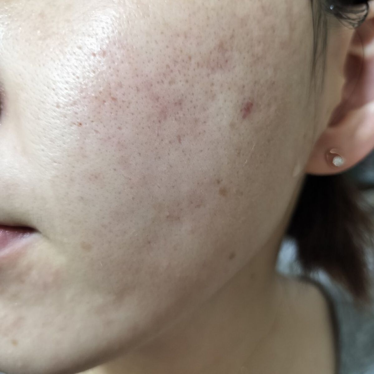 Azelaic Acid Suspension 10%/The Ordinary/美容液を使ったクチコミ（2枚目）