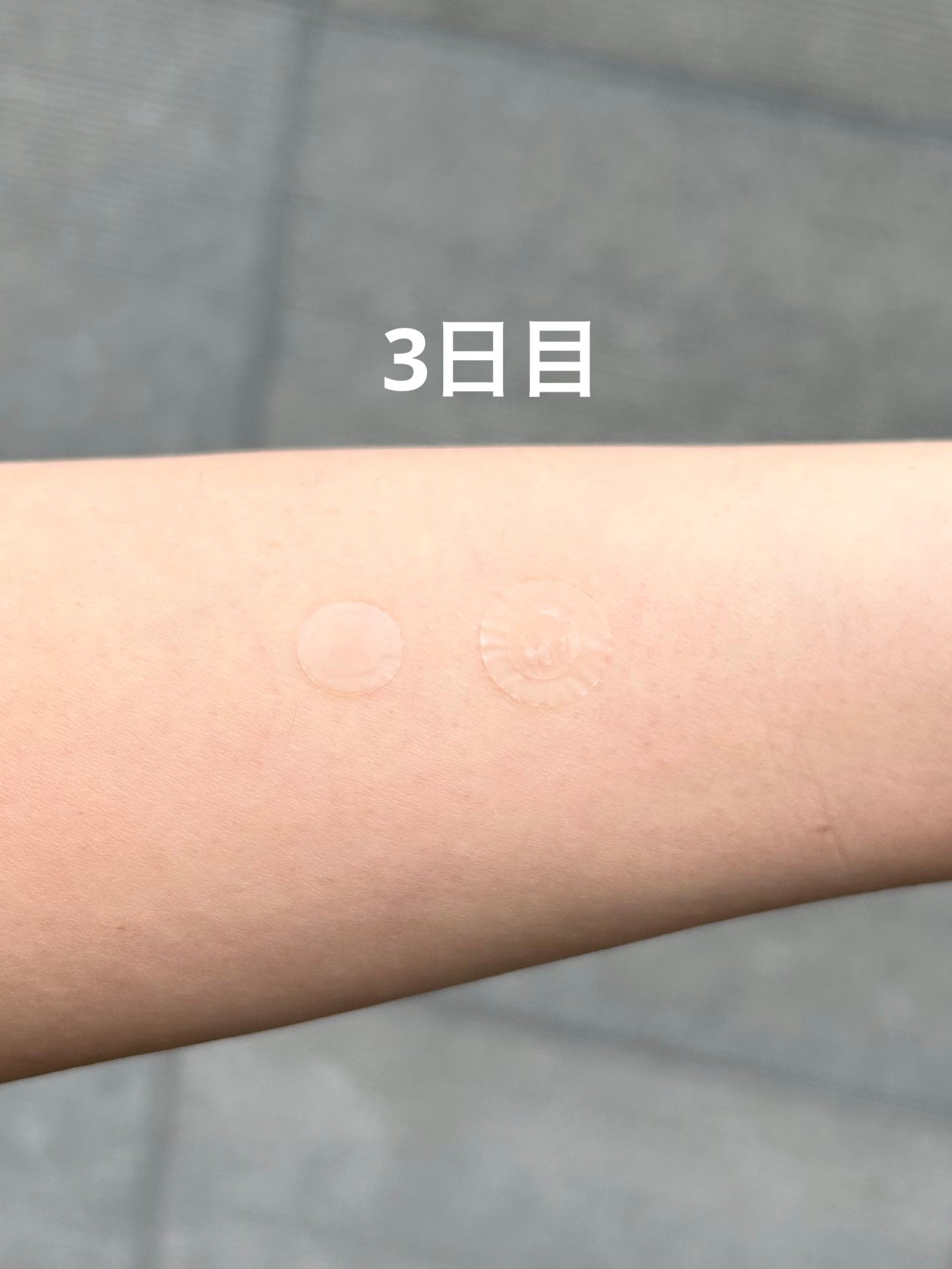 ビューティー スポットパッチ/イージーダムビューティー/にきびパッチを使ったクチコミ(4枚目)