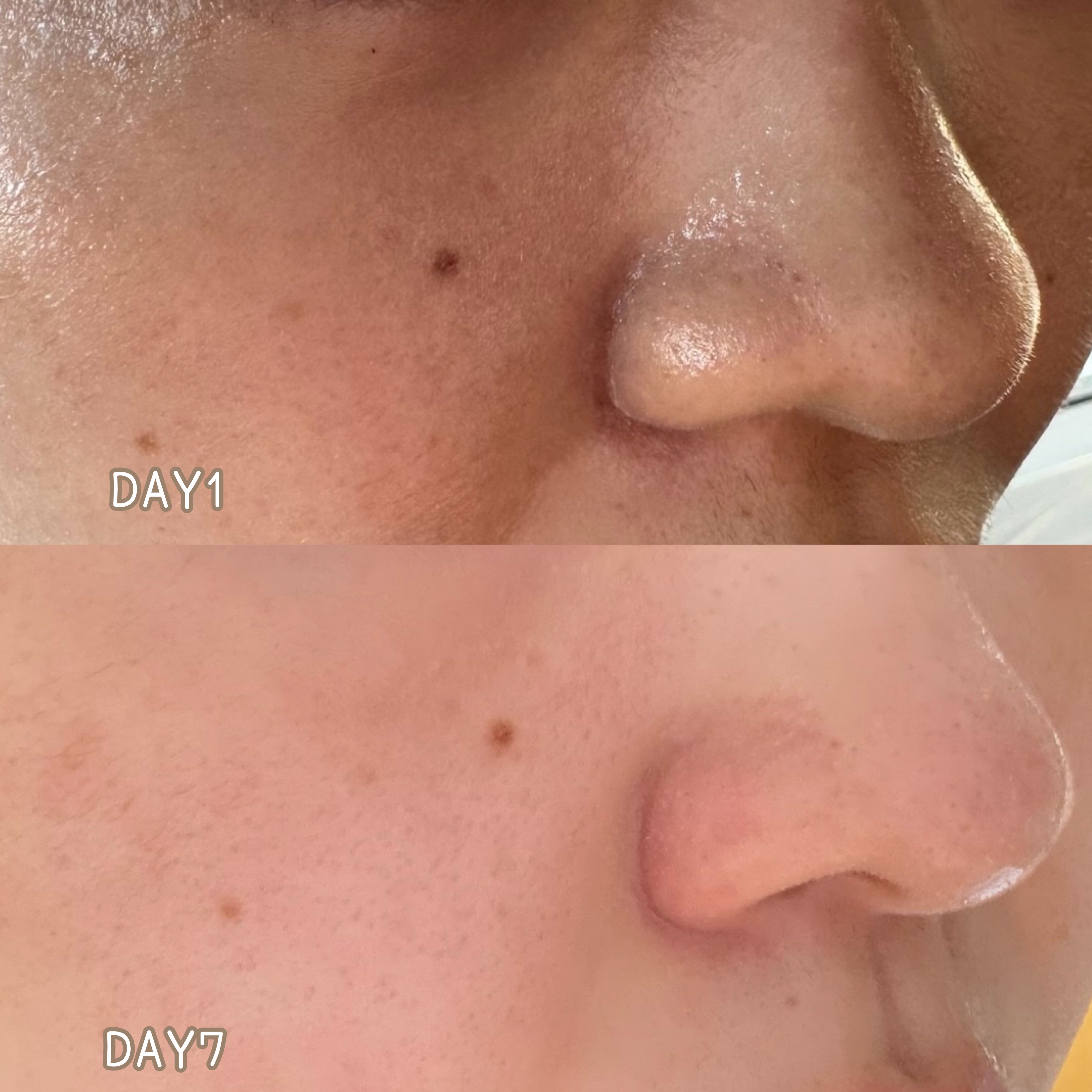 生VC美白美容液/Yunth/美容液を使ったクチコミ（1枚目）